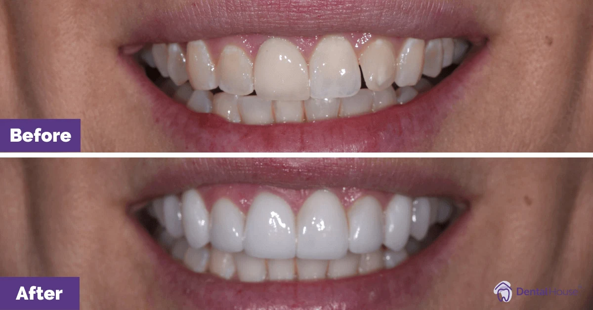 Hannah Of Melbourne’s Porcelain Veneers Makeover Gallery image