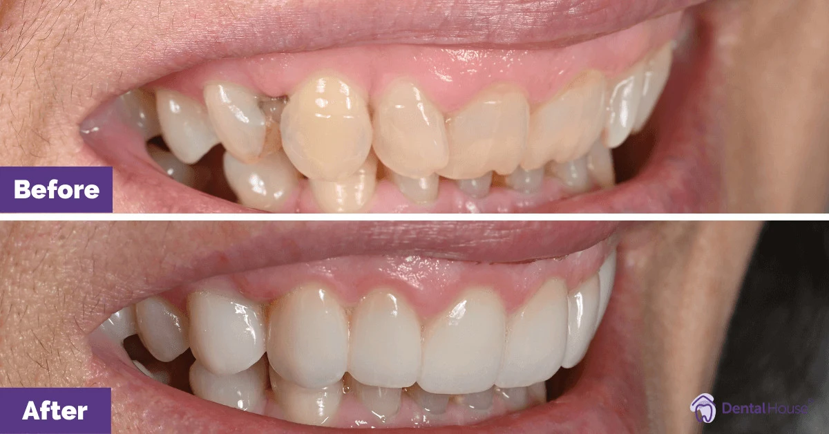 Joanna of Sunbury’s Gum Laser and Dental Veneers Journey Gallery image
