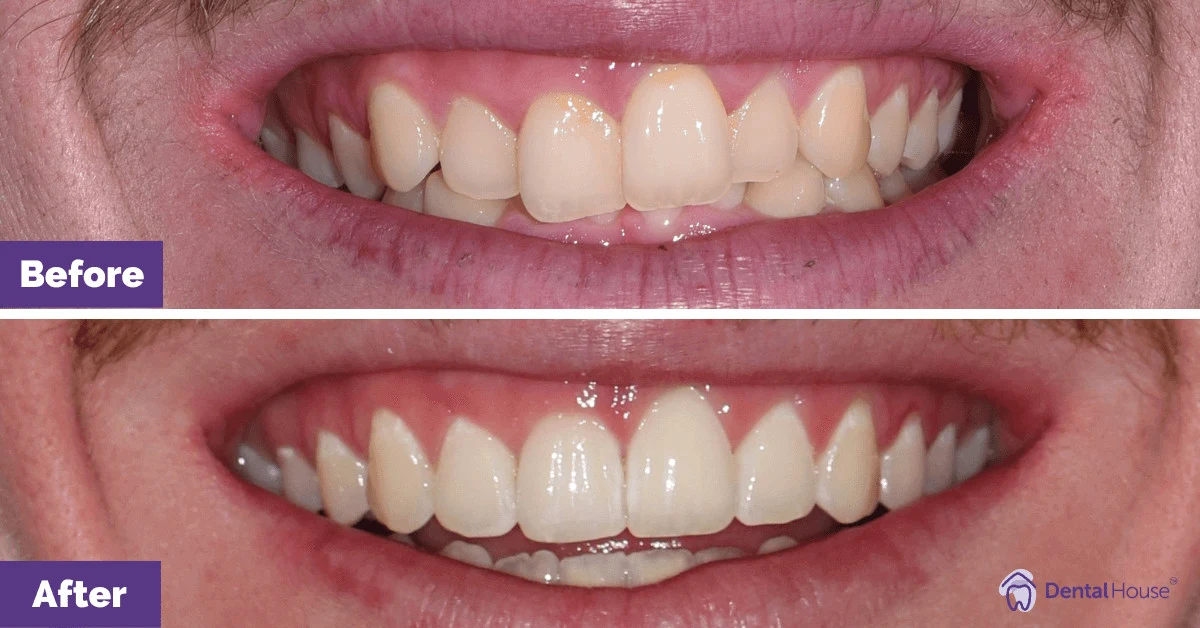 Kent of Bacchus Marsh’s Invisalign and Gum Contouring Makeover Gallery image