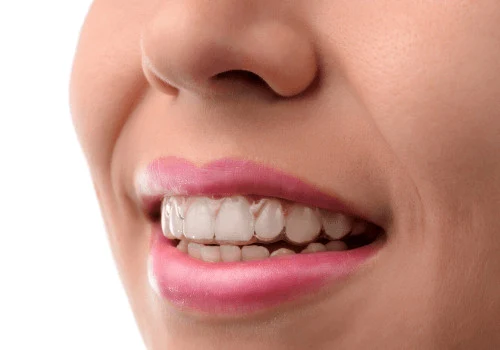 5 Reasons Why Its Dangerous to Straighten Your Teeth Other than Invisalign 500x350 1 1
