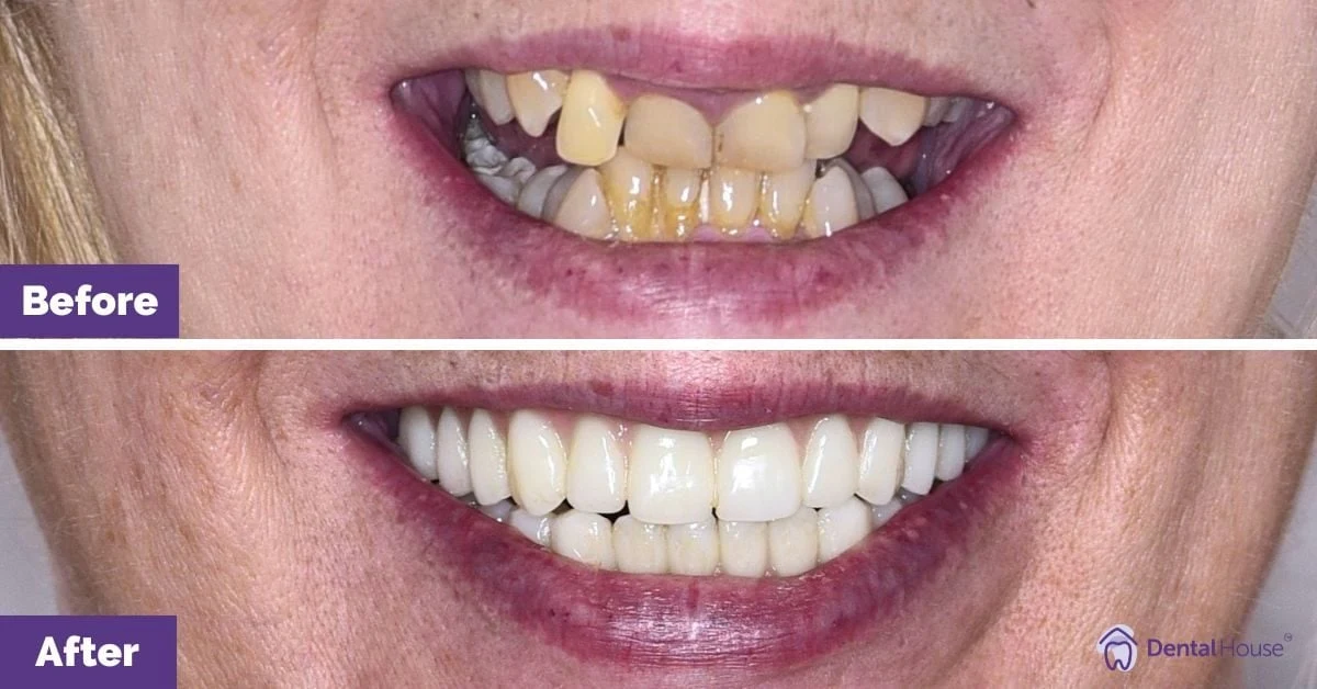Amanda of Melton’s All-on-4 Plus® Journey Gallery image
