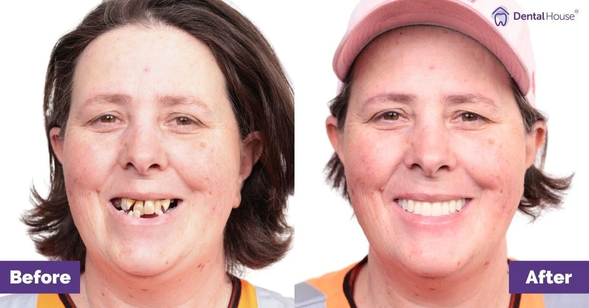 Anna of Sunbury’s All-on-4 Plus® Journey Gallery image