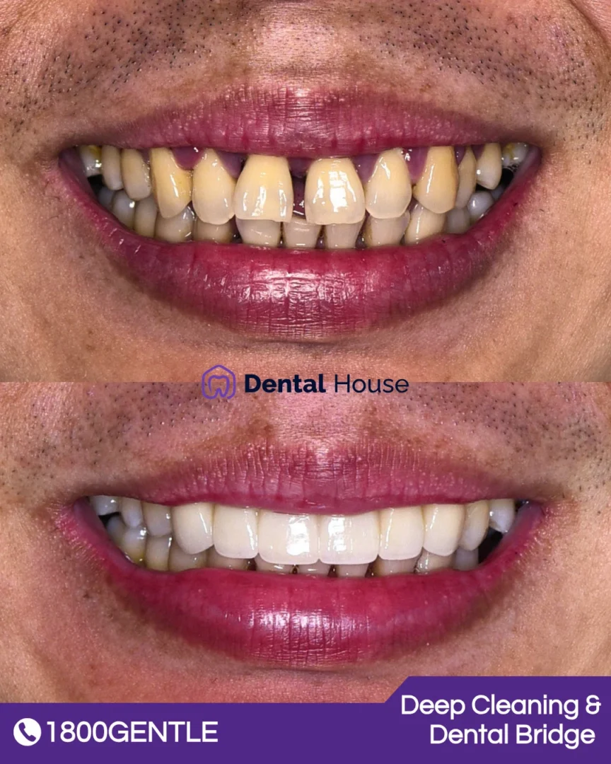 Deep Cleaning & Dental Bridge
