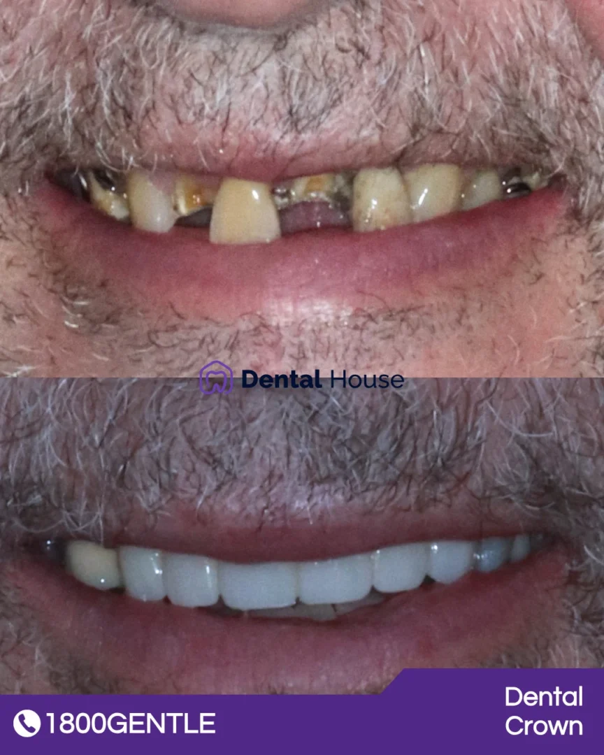 Dental Crown 038 Bridge