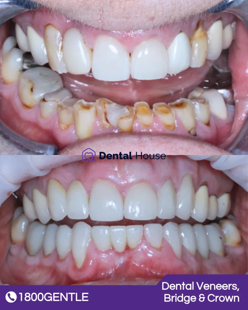 Dental Crown 038 Bridge