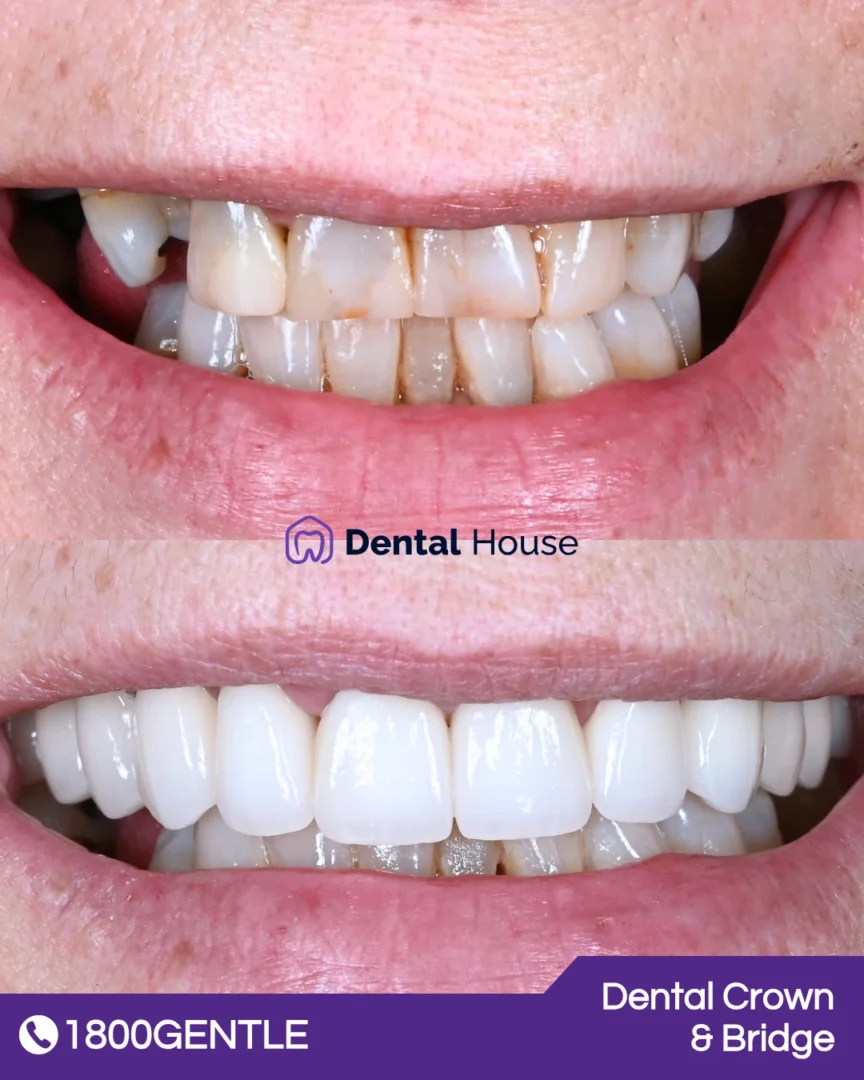 Dental Crown 038 Bridge