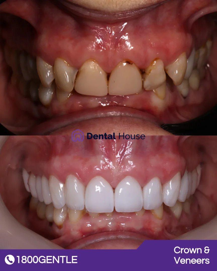 Dental Crown 038 Veneers
