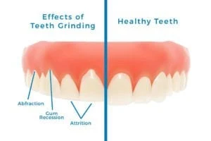 How to Stop Clenching Teeth to Protect Your Smile svg%3E