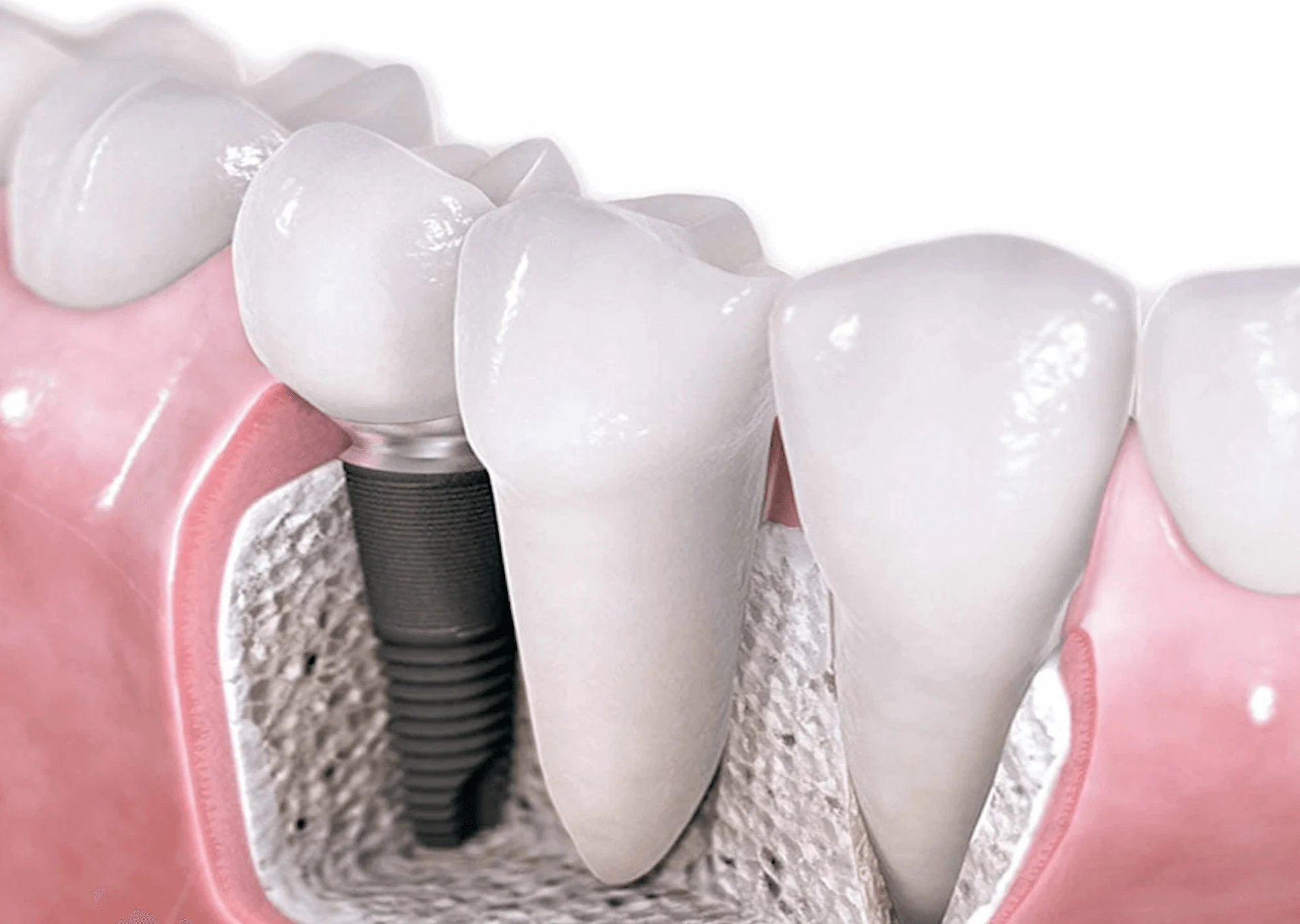 Dental Implant Dental House 1