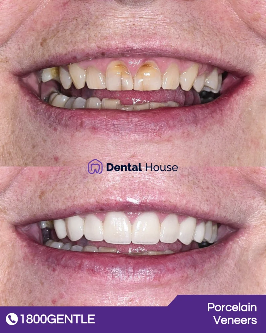 Porcelain Veneers
