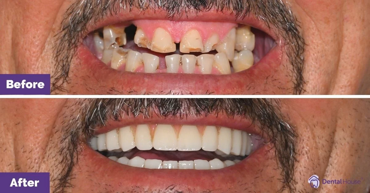 Frank of Sunbury’s All-On-4 Plus® Smile Makeover Gallery image