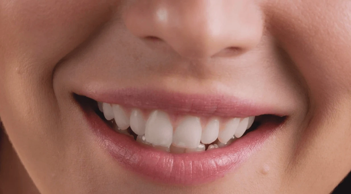 How Many Dental Veneers Should I Get 1