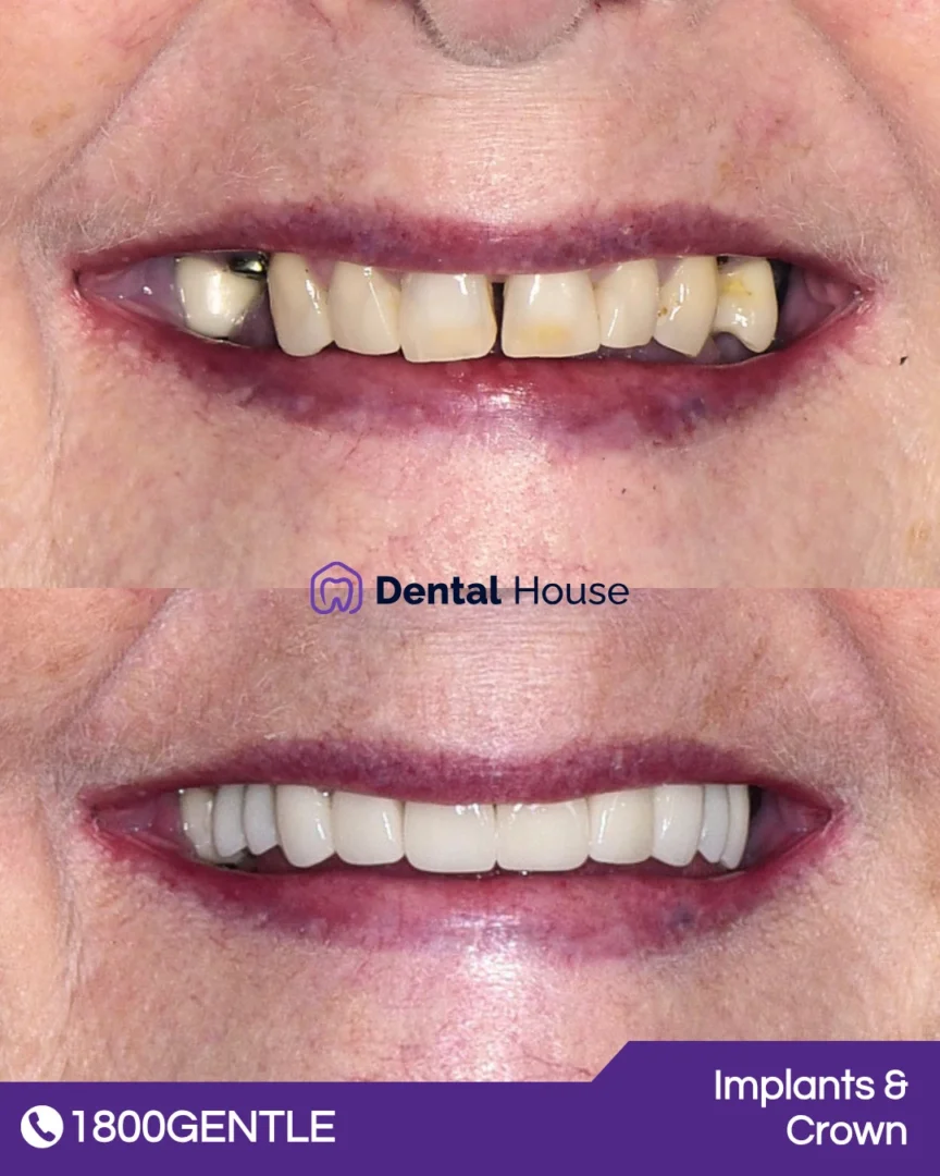 Implants & Crown
