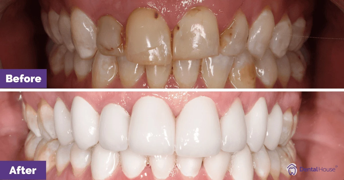 Kerry’s Porcelain Veneers in Bacchus Marsh Gallery image