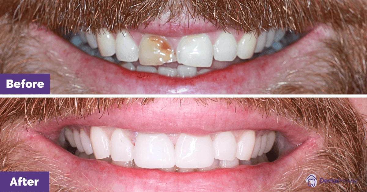 Marc of Rockbank’s Veneers and Teeth Whitening Makeover Gallery image