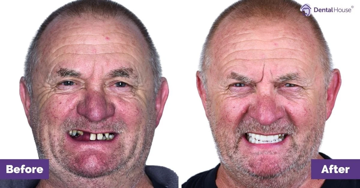Mark of Melton’s All-on-4 Plus® Smile Makeover Gallery image