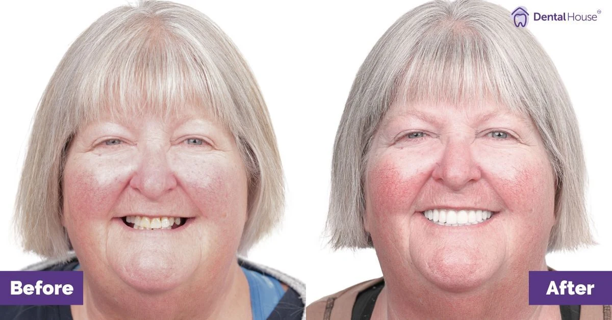 Meredith of Bacchus Marsh’s All-on-4 Plus® Smile Makeover Gallery image