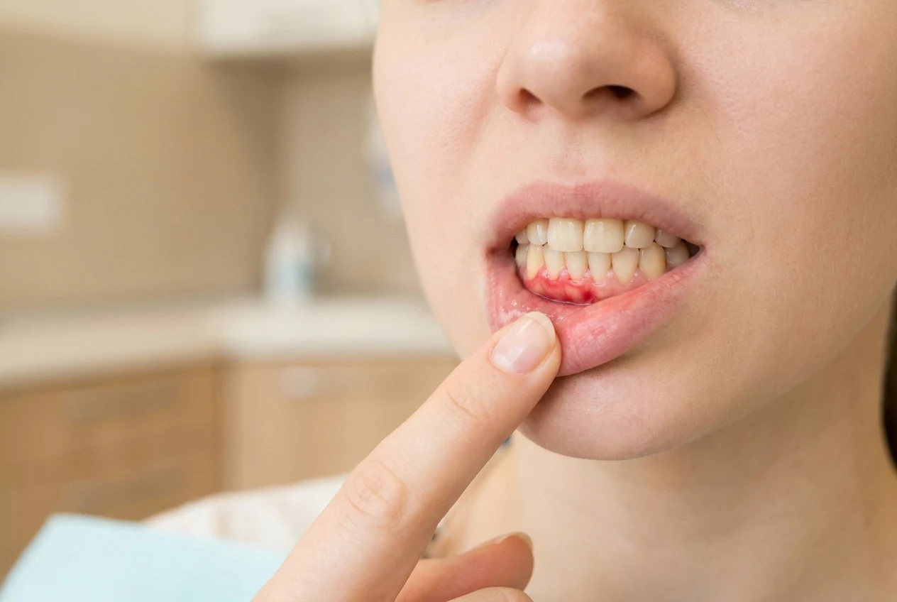 Periodontal Disease Causes and Prevention