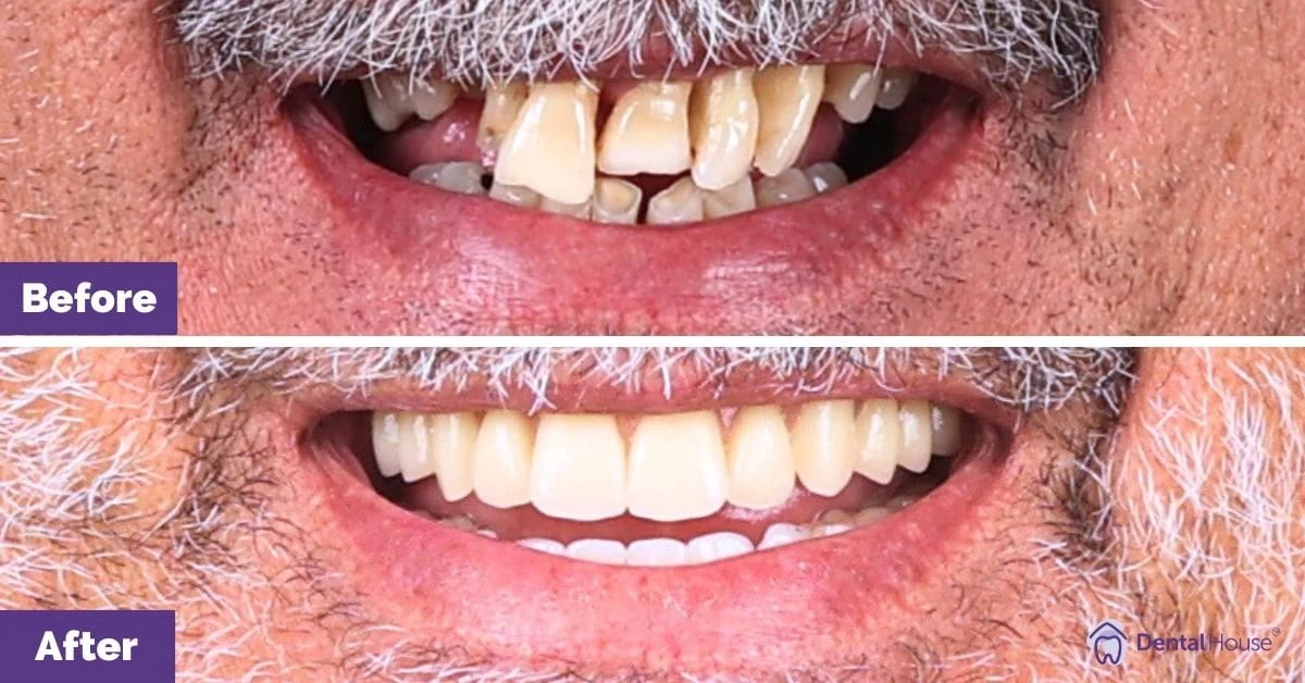 Peter of Melbourne’s All-On-4 Smile Makeover Gallery image