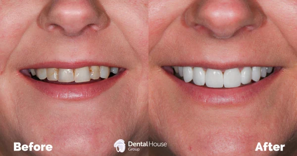 Porcelain Veneers for Discoloured Fillings Clinical Case in Melbourne 1