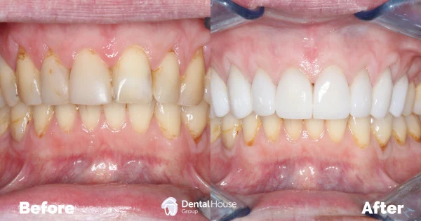 Replace Overseas Dental Work Clinical Case in Melbourne 1