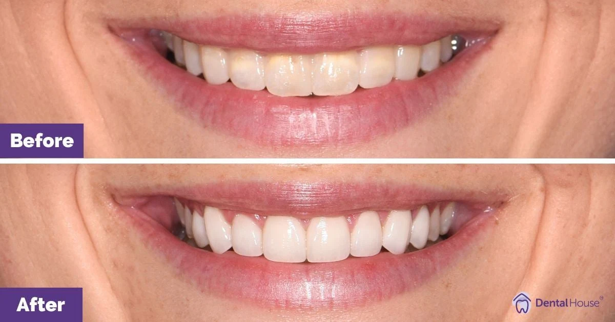 Tanisha of Melbourne’s Porcelain Veneers Smile Makeover Gallery image