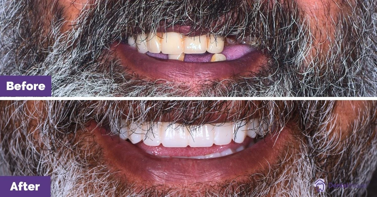 Tui of Sunbury’s All-On-Four® Smile Makeover Gallery image